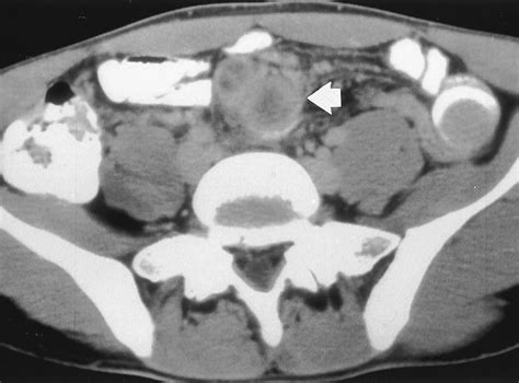 Abdominal Tuberculous Lymphadenitis Axial Contrast Enhanced Ct Scan