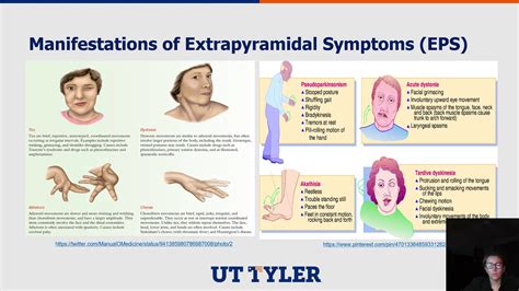 Extrapyramidal Motor Syndromes YouTube