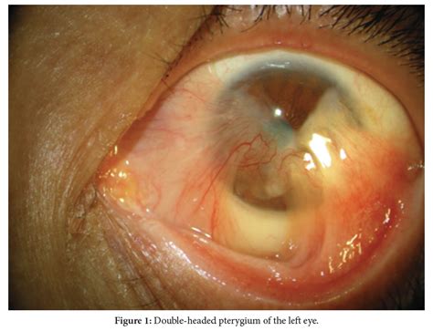 Double Head Pterygium Treated With Amniotic Membrane Graft