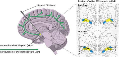 Deep Brain Stimulation Of The Nucleus Basalis Of Meynert For Parkinson