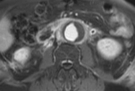 Retroperitoneal Fibrosis A Review Of Clinical Features And Imaging