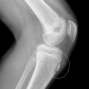 Болезнь Шляттера: симптомы у подростков, лечение болезни Шляттера ...