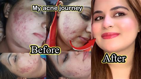 My Acne Journey How I Cleared My Acne Skin In 6 Months My Skin