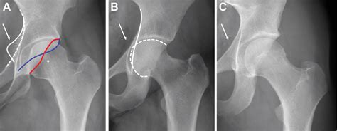 Figure From Location Of Intra And Extra Articular Hip Impingement Is