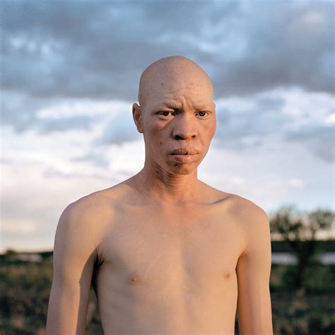 Рожденные быть другими. Люди-альбиносы и их особенная жизнь