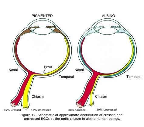 Ocular Albinism at emaze Presentation