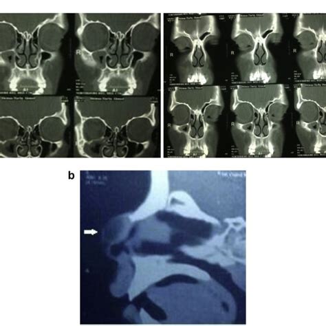 (a) Coronal CT scans showing a bifid crista galli in a 16-year-old ...