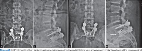 Figure 1 From Comparison Of The Early Results Of Transforaminal Lumbar Interbody Fusion And