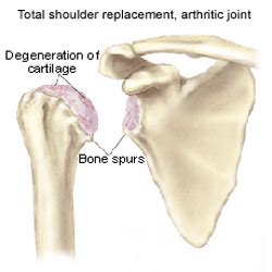 Glenohumeral Arthritis