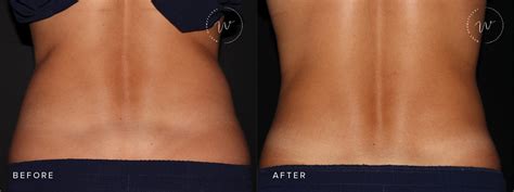 Maintaining Your Coolsculpting Results West Dermatology