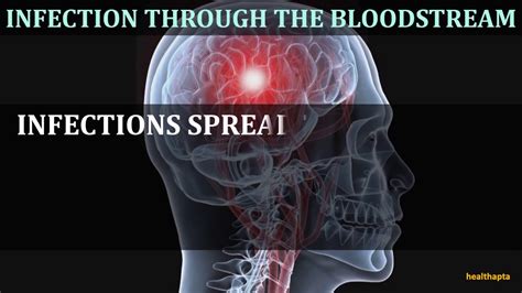 Causes Of Brain Abscess Youtube