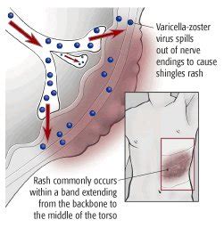 Shingles Herpes Zoster Guide Causes Symptoms And Treatment Options