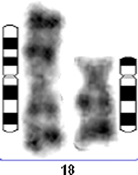 Prenatal Diagnosis Of I18q And Dup18q Cases By Quantitative Fluorescent Pcr Bmj Case Reports