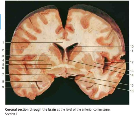 Diagram Of Brain Coronal Section At Anterior Commissure Quizlet