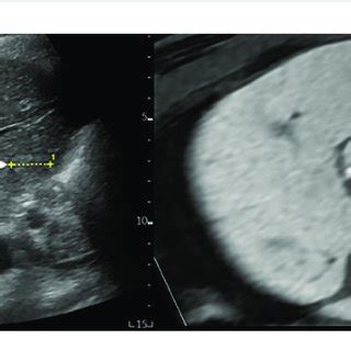 Mr Us Fusion Imaging Mri And Us Images With Hcc Measuring Cm In