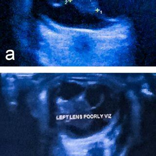 Ultrasound B-scan of (a) the right eye and (b) the left eye (b) showing ...