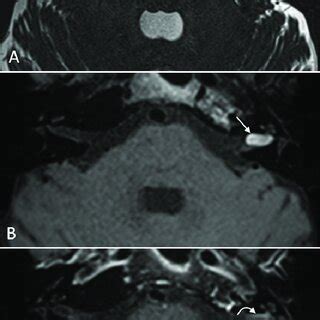 Normal Inner Auditory Canal And Labyrinthine Anatomy In A Year Old