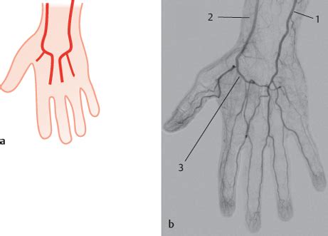 Deep Palmar Arch and Palmar Digital Arteries | Radiology Key