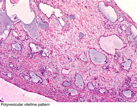 Pathology Outlines Yolk Sac Tumor