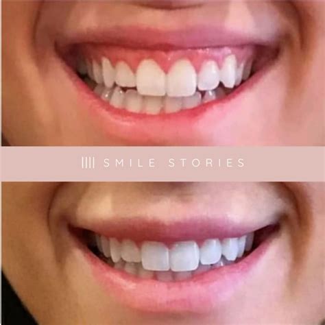 Gummy Smile Transformation Before And After Stories Radiant Youth Cosmos Sydney