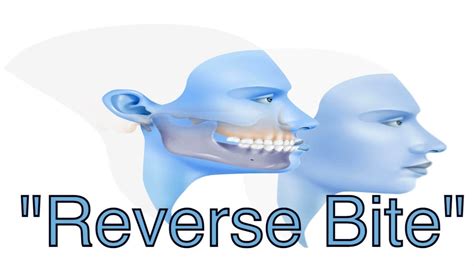 Underbite Correction Aka Reverse Overjet Reverse Overbite Skeletal 3 Malocclusion Youtube