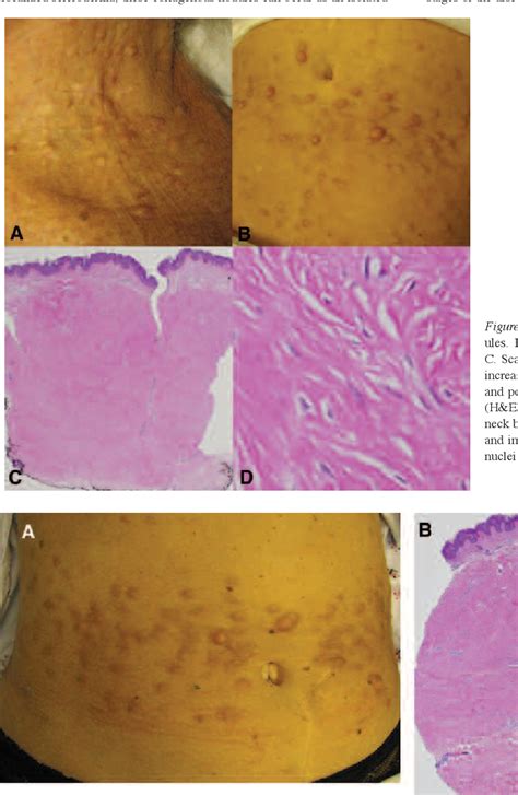 Figure 1 From Nodular Keloidal Scleroderma Acquired Collagenous