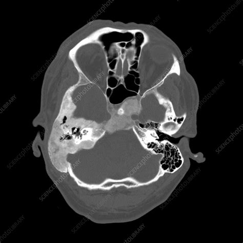 Fibrous Dysplasia Ground Glass