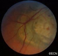 Choroidal Melanoma Ultrasound