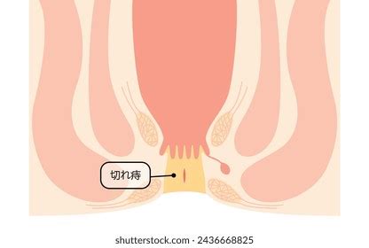 Diseases Anus Hemorrhoids Anal Fissures Illustration Stock Vector Royalty Free
