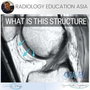 KNEE PLICA MRI MEDIAL PATELLAR PLICA RADIOLOGY - Radedasia