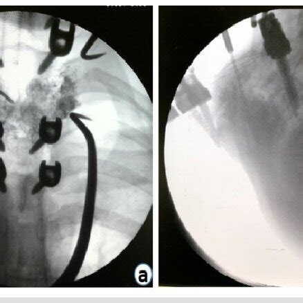 The fluoroscopy image at the end of the injection. (a) Posteroanterior ...