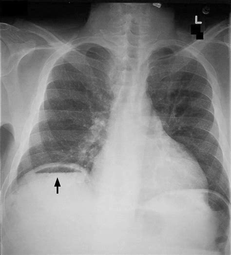 Pneumoperitoneo Wikipedia