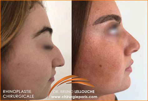 Rhinoplastie Chirurgicale Avant Apres Chirurgie Esth Tique Nice