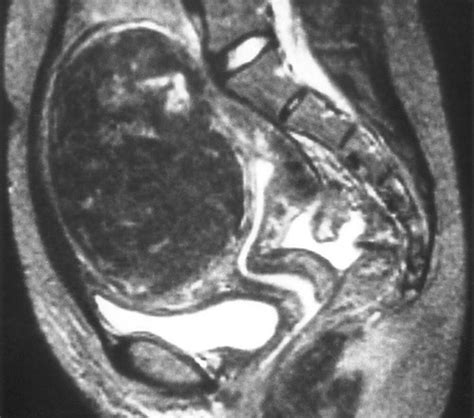 Unusual Appearances Of Uterine Leiomyomas MR Imaging Findings And