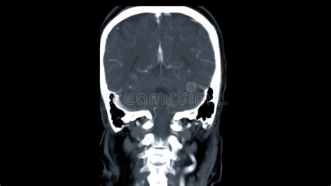 Ct Scan Of The Brain Axial View For Diagnosis Brain Tumor Stroke