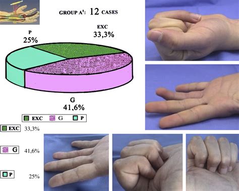 A Fresh Look At Vascularized Flexor Tendon Transfers Concept