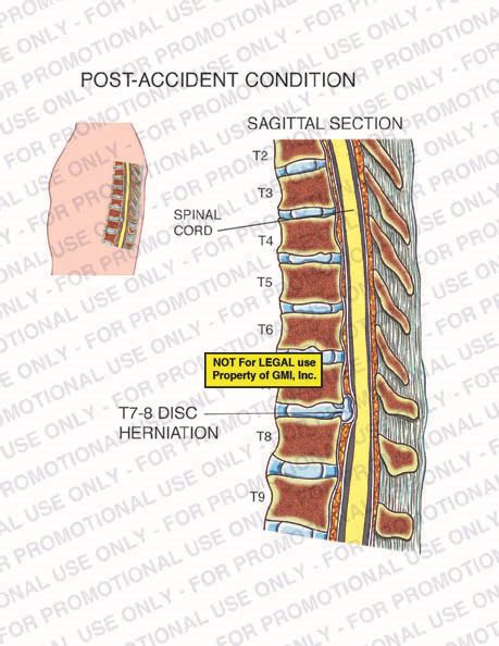 Post Accident Condition 96304a11a Generic Medical Legal Exhibits A Division Of Mvi