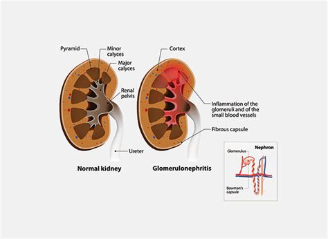 Glomerulonephritis Jnu Hospital