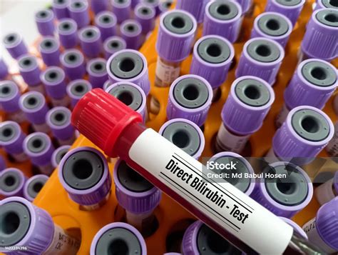 Blood Sample For Direct Bilirubin Test Liver Function Test Stock Photo ...