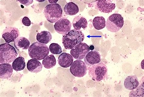 Acute Myeloid Leukemia Cells