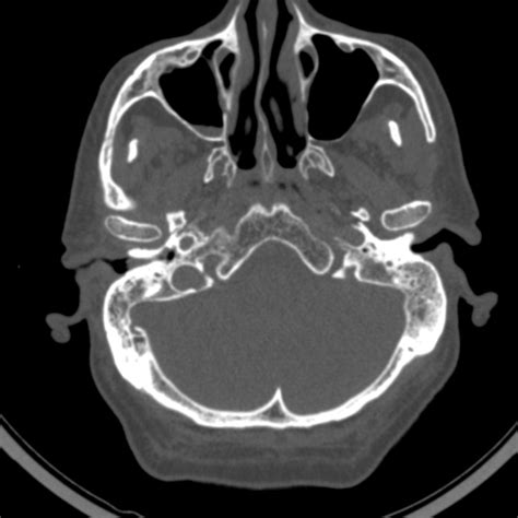 Radiopaedia case External auditory canal osteoma id: 56766 study: 63572 ...