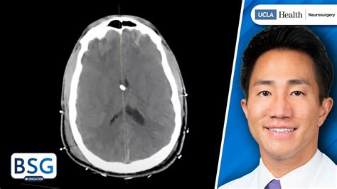 How To Calculate Intracranial Pressure