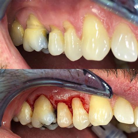 Tooth Wear Abfraction Lesions Dental Dentistry Dental Problems