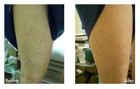 Spider Vein Treatment Best Solutions And Options For Patients