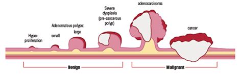 Bowel cancer - Guts UK