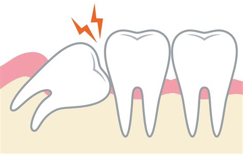 Estrazione Dei Denti Del Giudizio Clinica Odontoiatrica Centro Di