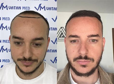 Hair Transplant In Mexico Tijuana Vatanmed Clinic