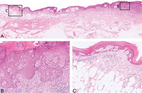 Invasive Extramammary Paget Disease Showing Intradermal Band Like Download Scientific Diagram