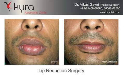 Lip Reduction Surgery in Ludhiana, Labiaplasty in Ludhiana, India