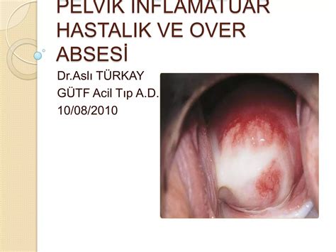 Pelvik Inflamatuar Hastalik Ve Over Absesi Fazlas I In